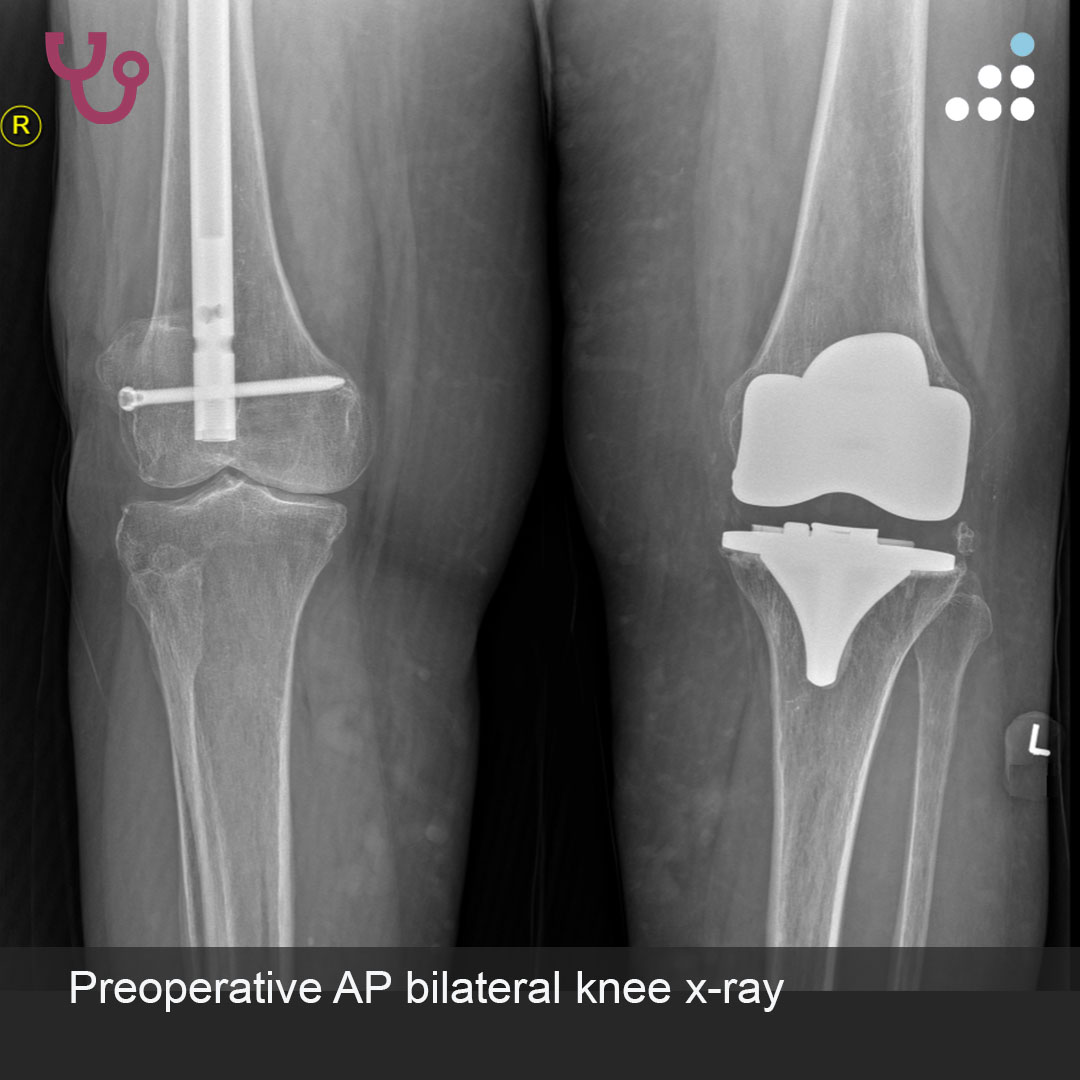 orthobullets's tweet image. Here is a new case by Dr. Marcus Ford and Texas Hip and Knee Center.

KNEE PAIN S/P RETROGRADE FEMORAL NAIL IN 67F

This case will be discussed at the 4th Annual Kinematic Knee Alignment Course in Las Vegas, NV, May 15-16, 2026.

How would you manage this #orthotwitter?

Vote on