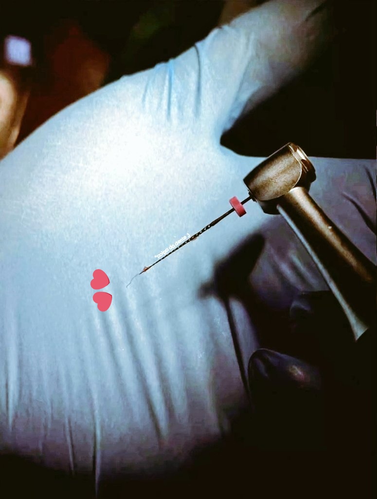 BornSinger97's tweet image. Olha moots, pra quem nunca viu como é a polpa do dente 🤧
É esse tecido inofensivo que faz você sentir dores arrepiantes. 🫶

#dentist #tiradentes feriado #odontologia #endo