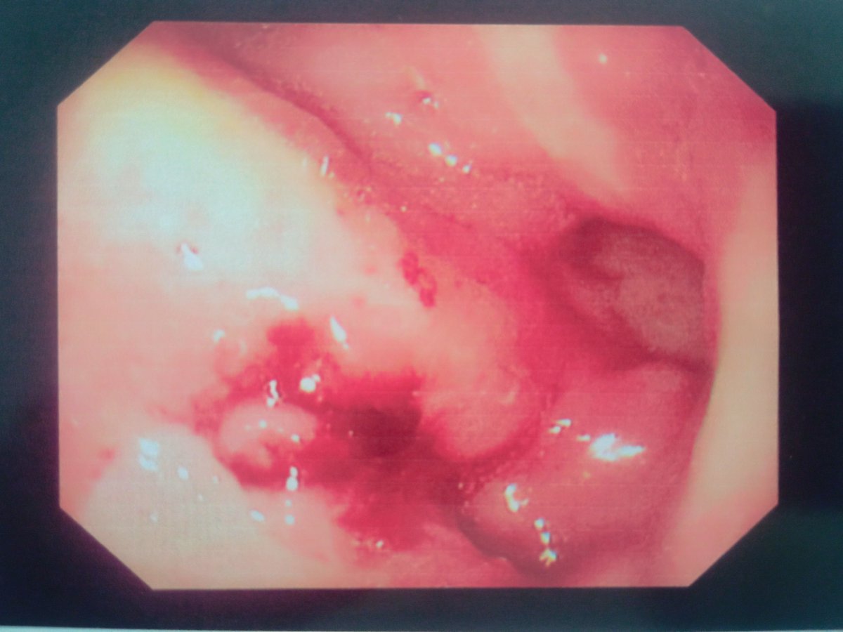 LuisCoello1418's tweet photo. Imagen de la semana. Mujer con hematemesis y melena, hemoglobina 3.4g/dl. Endoscopía mostró úlcera gástrica Forrest IIb. https://t.co/8awnjEogIV