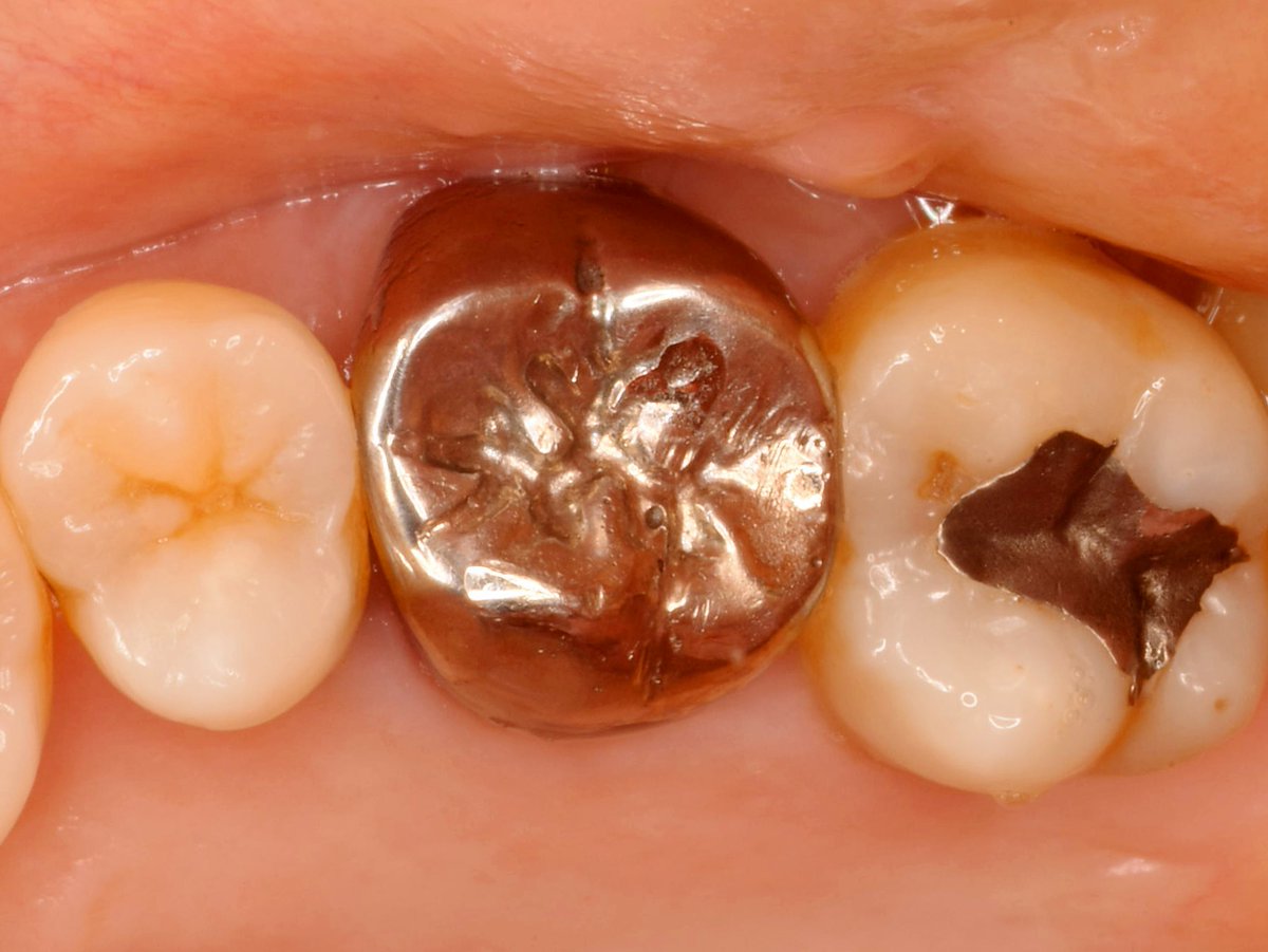 natural_clinic's tweet photo. 銀歯でかぶせてるから大丈夫——は、CBCTであっさり覆ります。
硬い金属の下で、根の一つに亀裂。副鼻腔にまで及ぶ病変。
銀歯を外す→マイクロで直視→隔壁＋ラバーダム→精密根管治療。
抜く前に、診る。

#銀歯 #歯根破折 #抜かない #根管治療 #マイクロスコープ #CBCT #share_your_dental_cases #歯科 #歯医者 #大阪 #梅田 #虫歯 #歯周病 #メタルフリー #歯列矯正