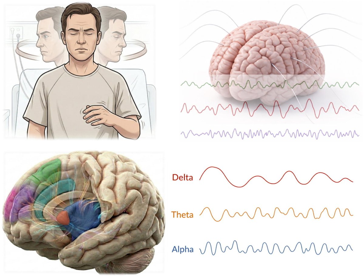 ClinicalNeuroph's tweet photo. [Epilepsy] Alotaibi et al.: ‘No-No’ head movements have been synonymous with non-epileptic seizures, but may infrequently be an ictal phenomenon. These movements may arise from
https://t.co/cT1kk7GqK8 https://t.co/Q8nz9L4sKZ