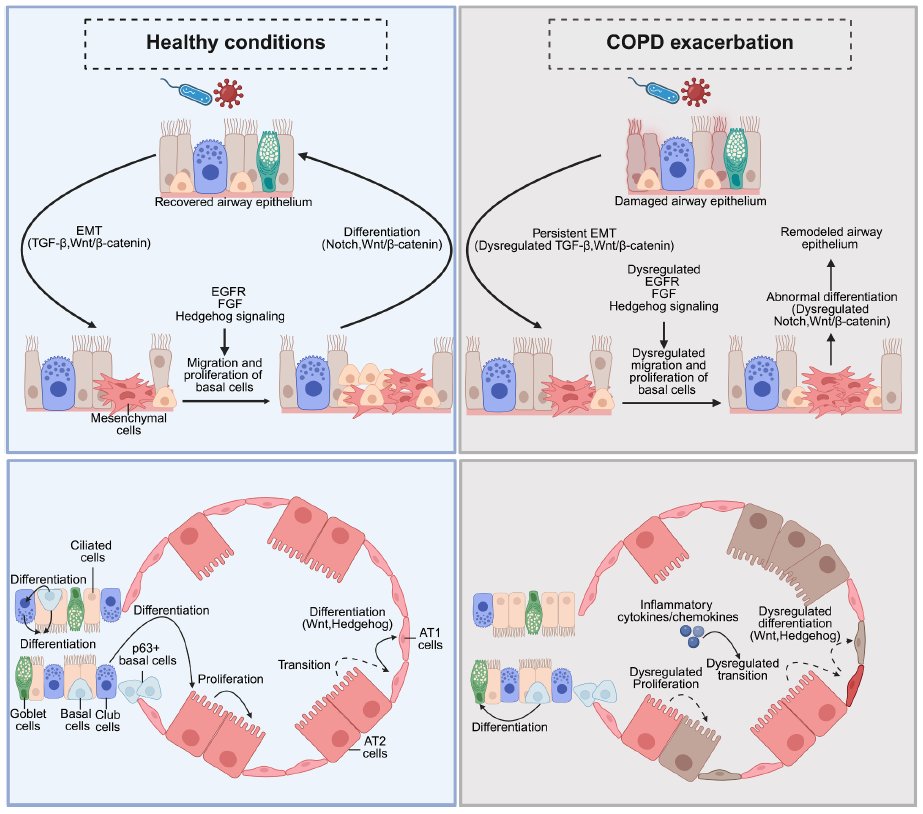 fritsfranssen's tweet photo. COPD exacerbations are characterized by epithelial barrier disruption, dysregulated inflammation, and impaired repair. This figure shows epithelial repair processes in both healthy conditions and COPD exacerbation. https://t.co/JhpOteSdKR https://t.co/hzcPLVJgpr