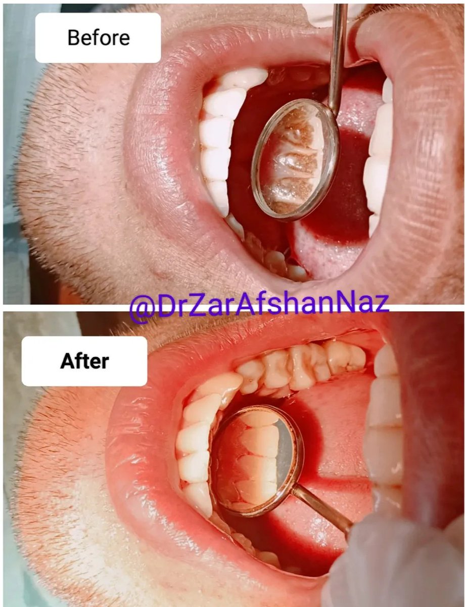 DrZarAfshanNaz's tweet image. Teeth cleaning...
Scaling &amp;amp; Polishing 🦷✨

#Dentist #DentalHealth #OralHealth