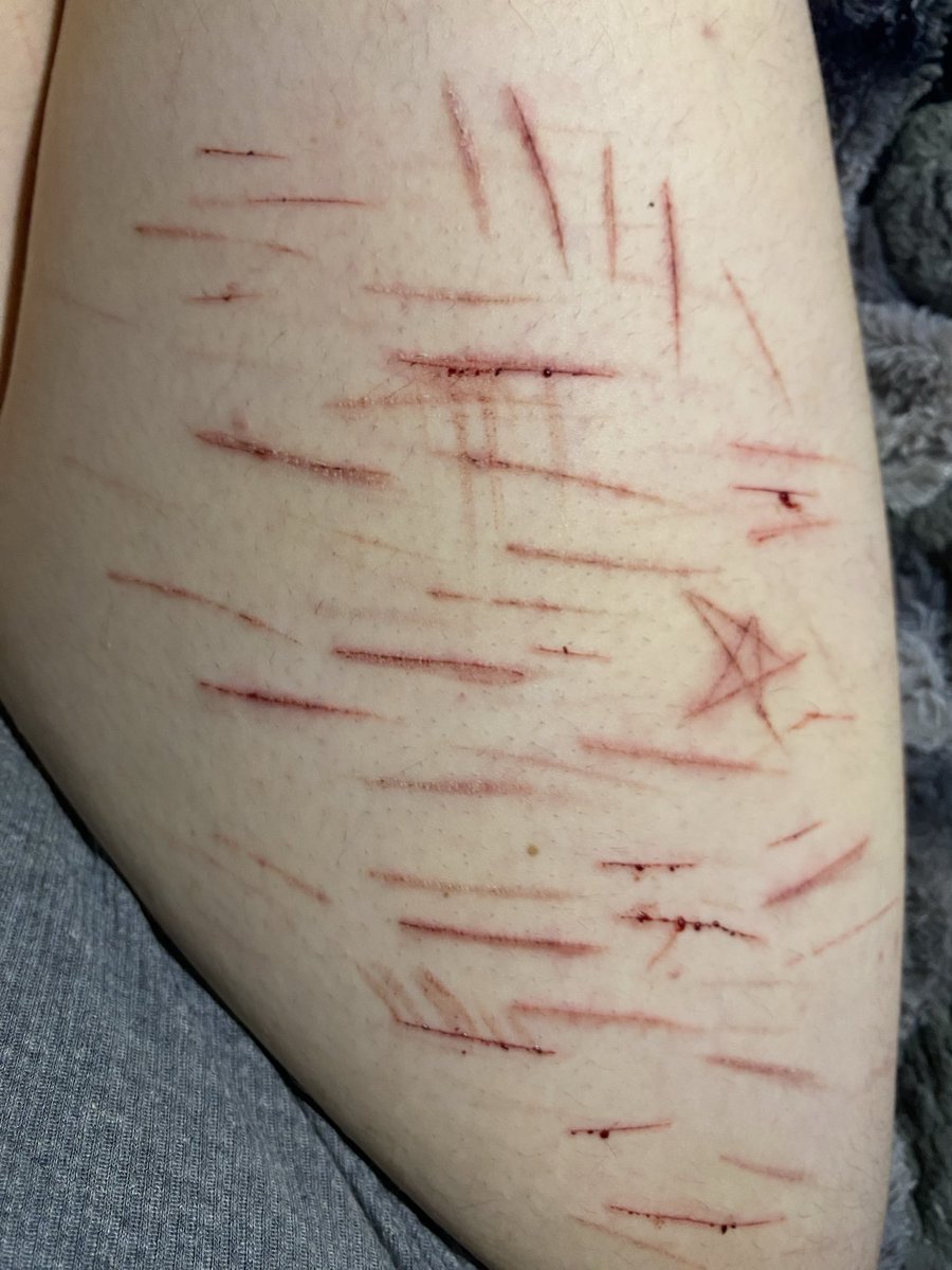 skiniixkay's tweet image. I feel like I’m going to regret this when it starts getting hot out..

Tw// Sh, cuts, blood

(Some old some new)

#shtwt #shedtwt #cuts #cvts #cutspo