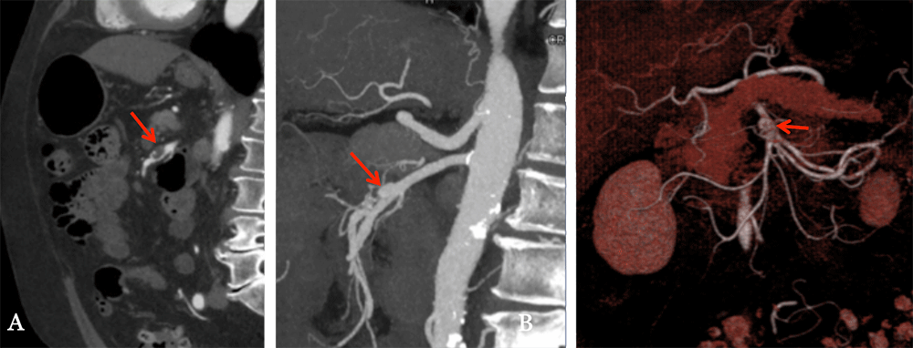 bwells80's tweet image. #RT @ctisus: SMA Aneurysm

69-year-old male with abdominal pain and an incidental aneurysm found at outside hospital. Sagittal image (A) demonstrates a partially thrombosed aneurysm of the SMA (red arrow). The sagittal MIP image (B) easily depicts the an…