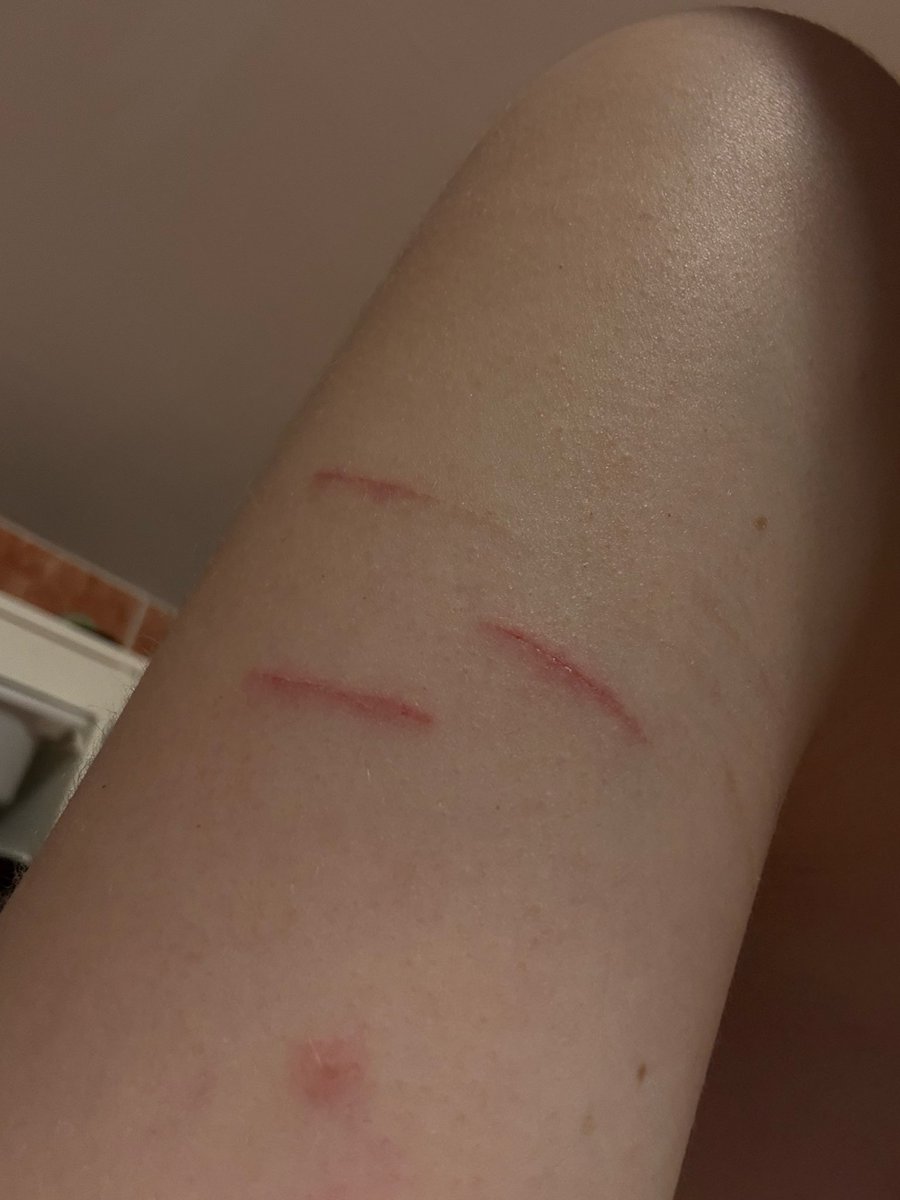 rotandblood's tweet image. One day of healing and they are doing so good already #shtwt #shedtwt #cut #healing #styro