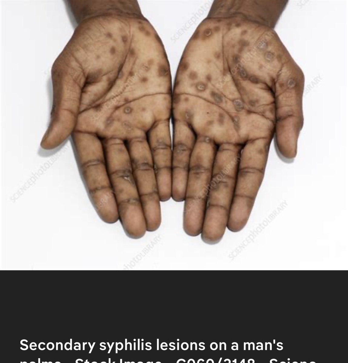 mkborg67's tweet photo. @AmericaPapaBear Could be secondary syphilis. If it’s real, should be referred to public health. https://t.co/Lxg3zWUxsH