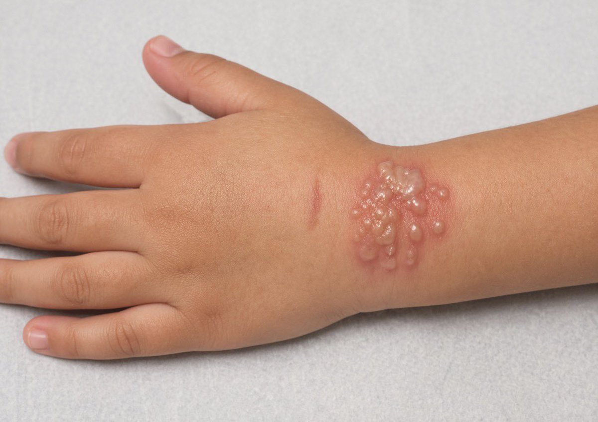 dermatology's tweet photo. Diagnosis? https://t.co/LVeEjBusJd