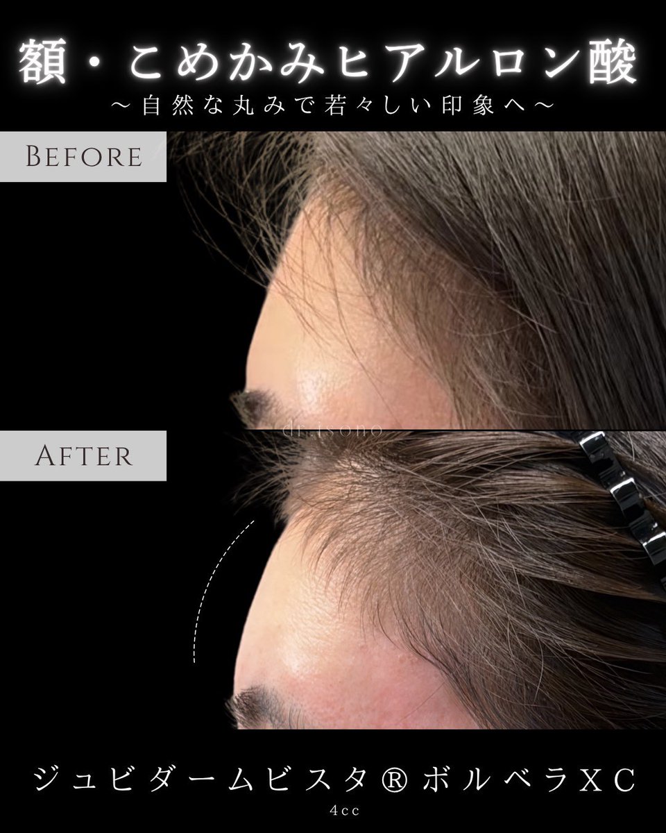 dr_isono's tweet photo. 額・こめかみのヒアルロン酸。

凹みを単純に埋めるだけでなく、
周囲とのバランスを見ながら調整しています。

少し整うことで、
見え方が変わることがあります。

ジュビダームビスタ® ボルベラXC
4cc

※腫れ・内出血などが生じる場合があります
※仕上がりには個人差があります https://t.co/AI8pRMktqW