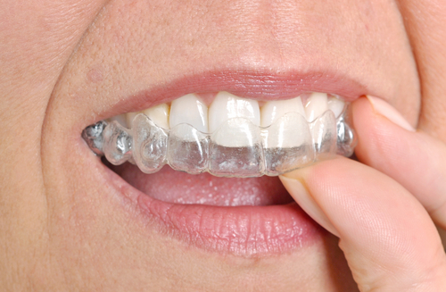 rickmillerdds's tweet image. See why invisible braces are the clear winner over metal braces in this video Q&amp;amp;A. Straighten teeth discreetly with Invisalign treatment. #dallas #dentalimplants #dentist bit.ly/48c0XhJ