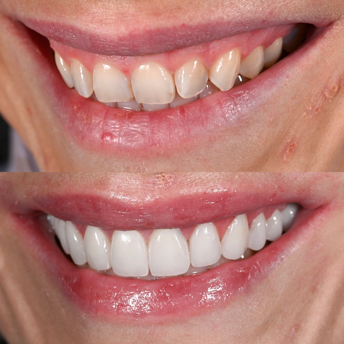droliviamoran's tweet photo. So happy for my wonderful patient! I did 14 veneers/crowns and a gum lift (crown lengthening) to give her a brand new smile!! She has always wanted to improve her smile but hadn’t been to the dentist in a while as she was not a big fan of dental visits (who is?? 😂). She finally decided to take the next step and she couldn’t be happier. I gave her a brand new smile but also tackled a lot of large cavities she had, hence why she needed some crowns. Now she takes amazing care of her teeth and never misses an appointment!
