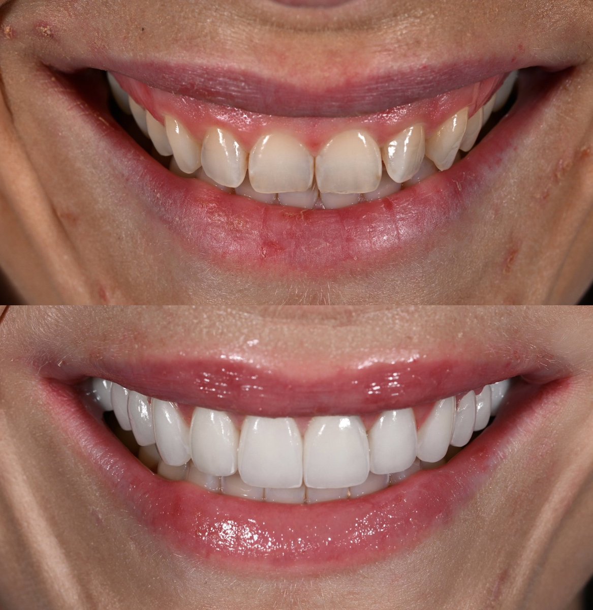 droliviamoran's tweet photo. So happy for my wonderful patient! I did 14 veneers/crowns and a gum lift (crown lengthening) to give her a brand new smile!! She has always wanted to improve her smile but hadn’t been to the dentist in a while as she was not a big fan of dental visits (who is?? 😂). She finally decided to take the next step and she couldn’t be happier. I gave her a brand new smile but also tackled a lot of large cavities she had, hence why she needed some crowns. Now she takes amazing care of her teeth and never misses an appointment!