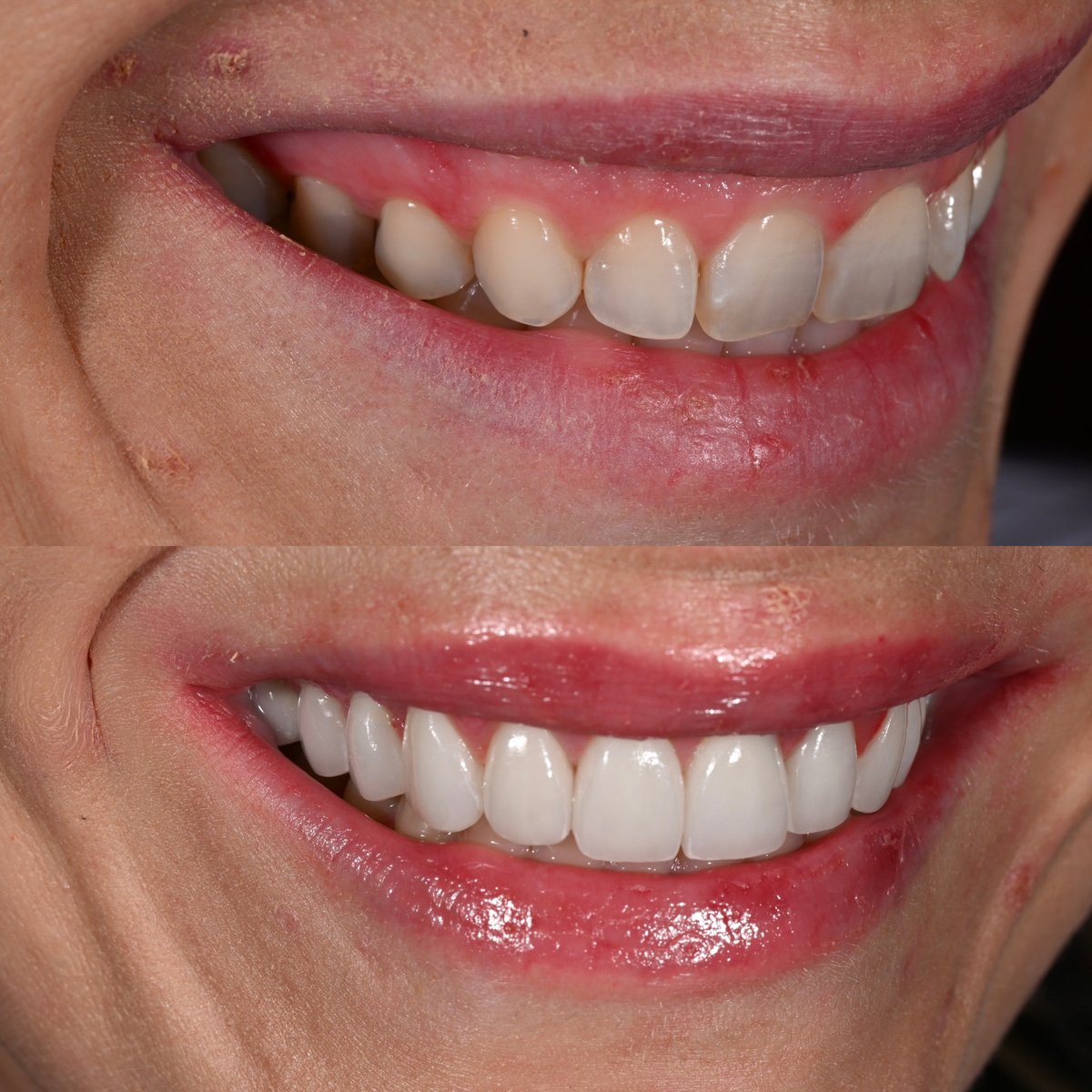 droliviamoran's tweet photo. So happy for my wonderful patient! I did 14 veneers/crowns and a gum lift (crown lengthening) to give her a brand new smile!! She has always wanted to improve her smile but hadn’t been to the dentist in a while as she was not a big fan of dental visits (who is?? 😂). She finally decided to take the next step and she couldn’t be happier. I gave her a brand new smile but also tackled a lot of large cavities she had, hence why she needed some crowns. Now she takes amazing care of her teeth and never misses an appointment!
