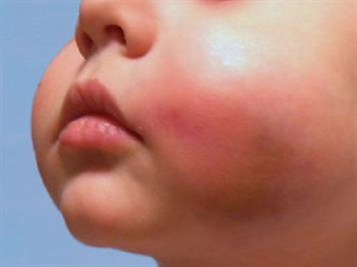 AboutKidsHealth's tweet image. Cellulitis is a common skin infection that makes the skin look swollen and red. The infected area may also be warm and painful. Read more about cellulitis in children: ow.ly/O2ll50YHir7 #Cellulitis #SkinInfection #Infection