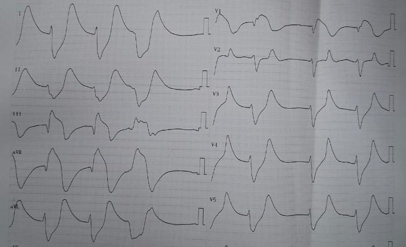 Thromboxane A2 Inhibitor tweet media