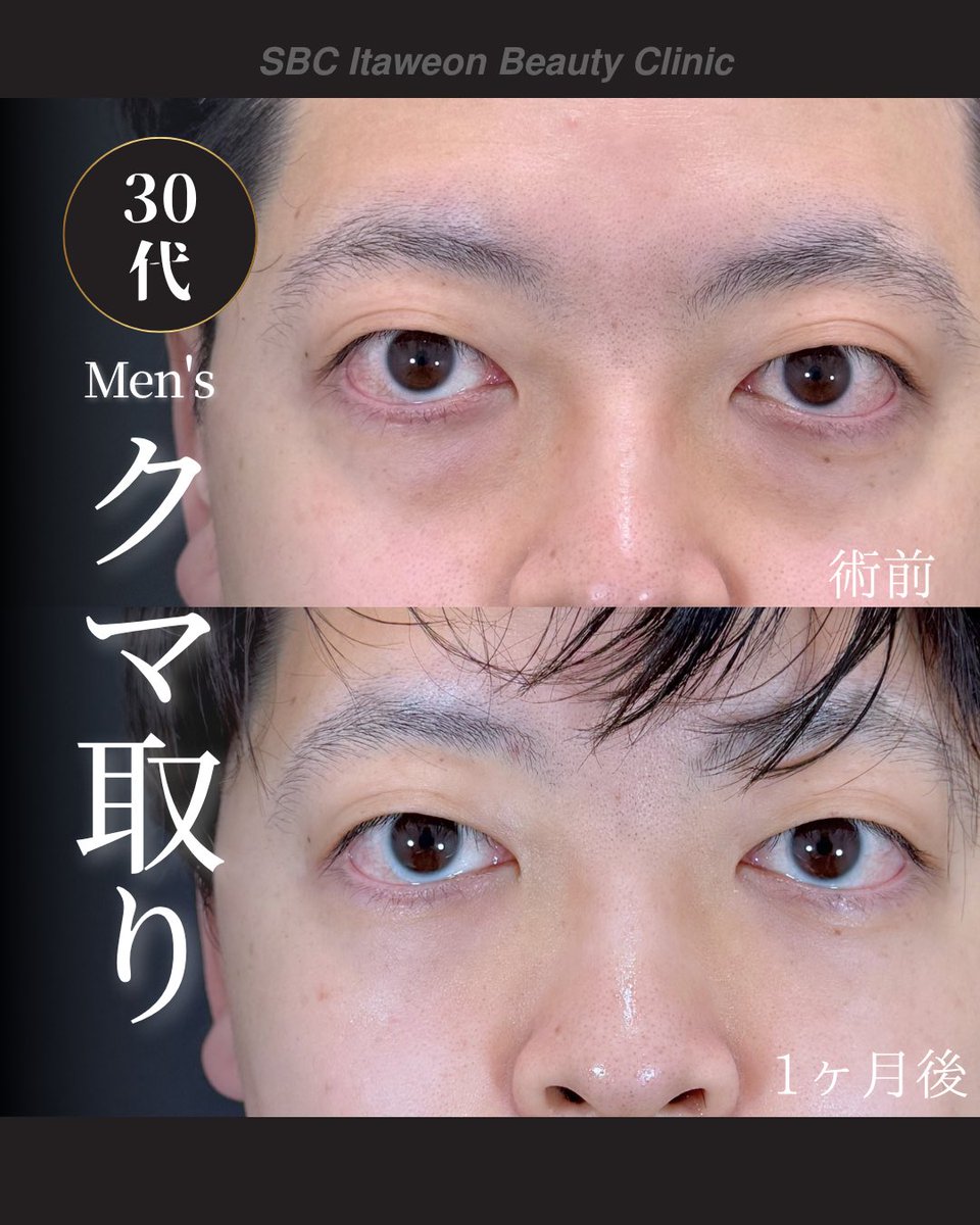 小顔輪郭整形 | 小顔KING(濱田純) / イテウォン名古屋栄院 tweet media
