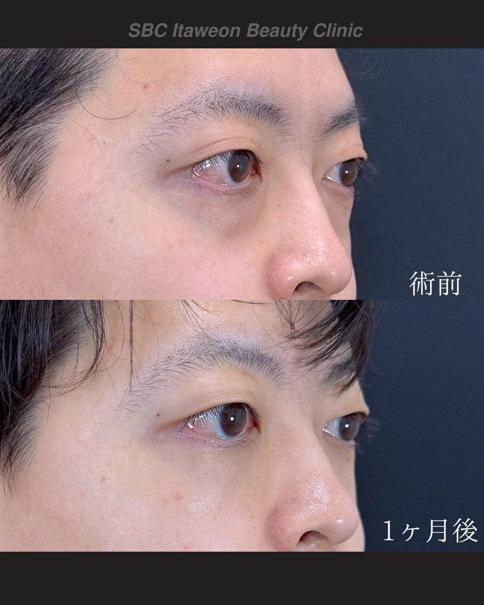 小顔輪郭整形 | 小顔KING(濱田純) / イテウォン名古屋栄院 tweet media