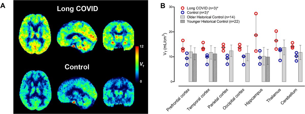 vipintukur's tweet image. #LongCOVID in older adults may have a measurable brain basis.

➡️ In a NEW study, patients showed higher depression and fatigue, with PET imaging revealing increased neuroinflammation—pointing toward a biological driver of persistent symptoms, albeit with limited
