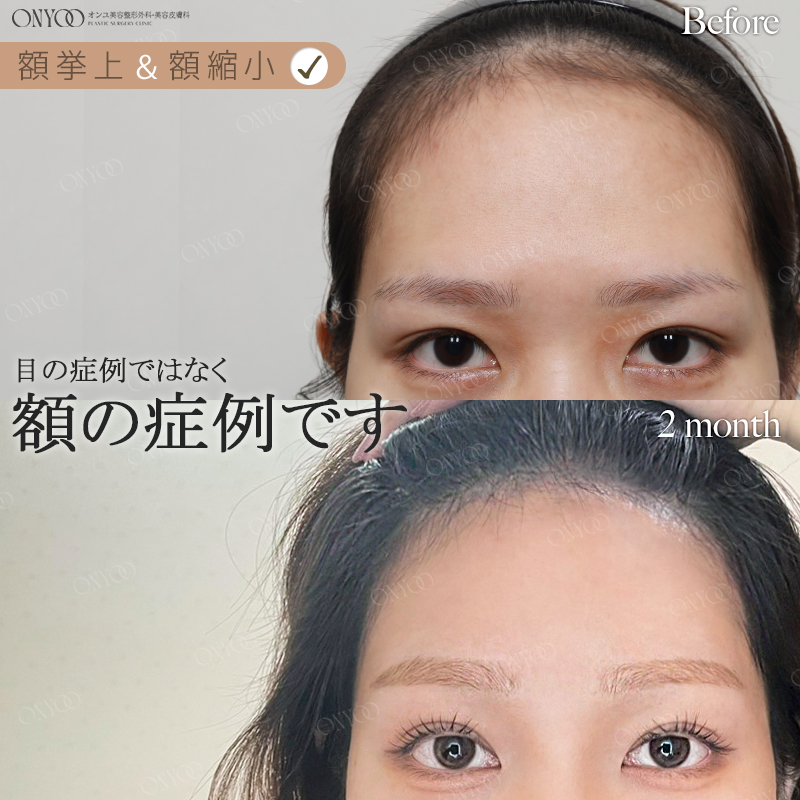 オンユ美容整形外科・美容皮膚科 【額縮小/挙上/リフトアップ】専門🎖 tweet media