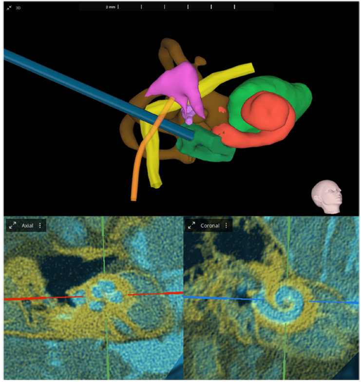 MPs_MDPI's tweet photo. 👂Advances in 3D Inner Ear Reconstruction Software for Cochlear Implants: A Comprehensive Review
👥Pinelopi Samara et al.
🔗 https://t.co/3nyzY0Uf85
📜6 citations | 4562 views
#cochlearimplants #hearingloss #software #3Dinnerearreconstruction #segmentation #auditoryimpairment https://t.co/NbuA3Bj87h