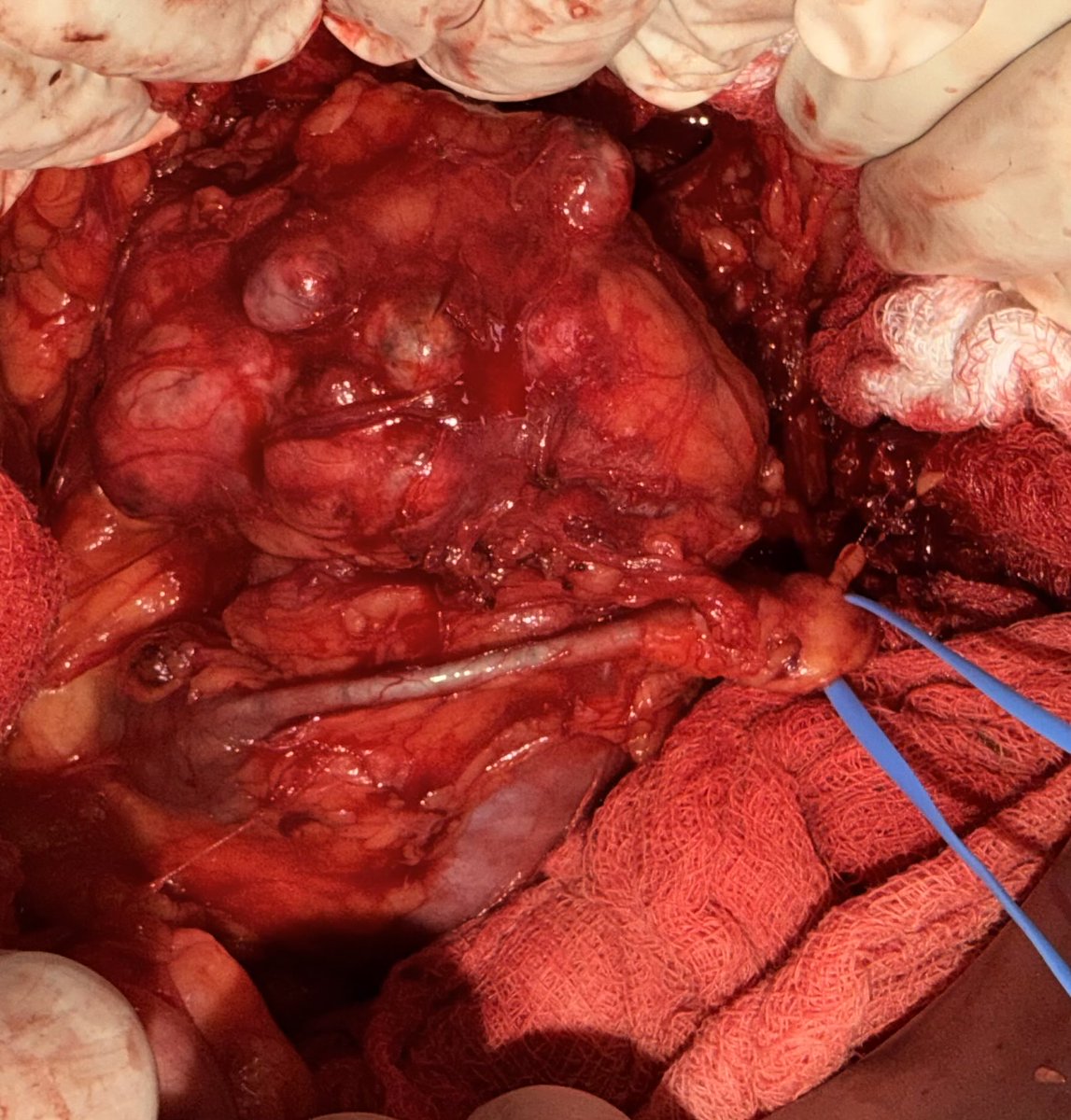 Prezz1305's tweet photo. Successfully managed a rare and challenging case of a large tumor arising from the isthmus of a Horseshoe Kidney. Careful preoperative planning and meticulous intraoperative execution were key to achieving an optimal outcome. Sharing select intraoperative images nd post-procedure https://t.co/HFpa8iIIaa