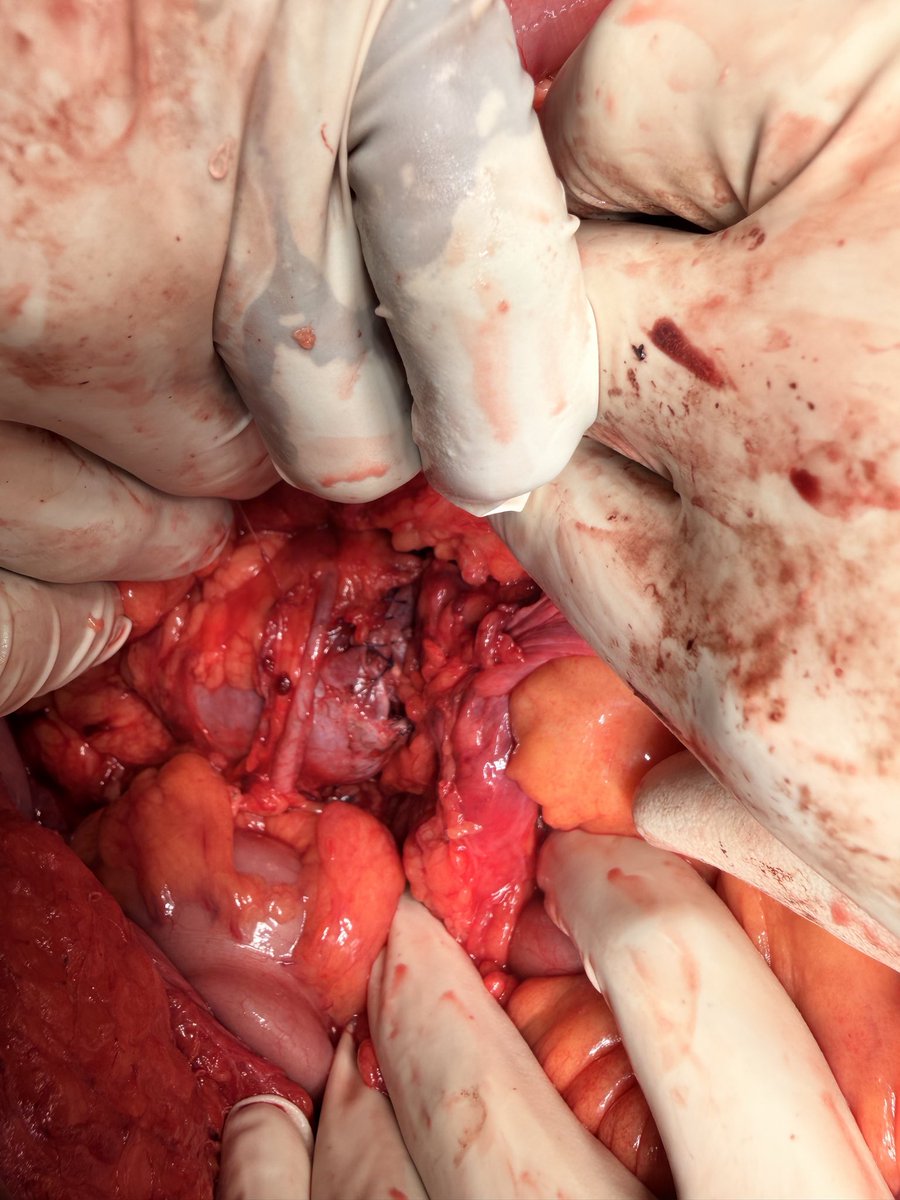 Prezz1305's tweet photo. Successfully managed a rare and challenging case of a large tumor arising from the isthmus of a Horseshoe Kidney. Careful preoperative planning and meticulous intraoperative execution were key to achieving an optimal outcome. Sharing select intraoperative images nd post-procedure https://t.co/HFpa8iIIaa