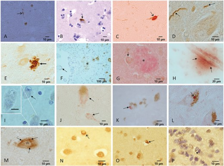 ScienceofPD's tweet image. Analysis of postmortem brains from children &amp;amp; young adult from fine particulate matter (PM2.5)-exposed metropolitan Mexico City (n=189, avg age=26yrs) finds 37% of under 17yrs had evidence of #Alzheimers &amp;amp; #Parkinsons-associated neuropathological markers
academic.oup.com/jnen/advance-a…