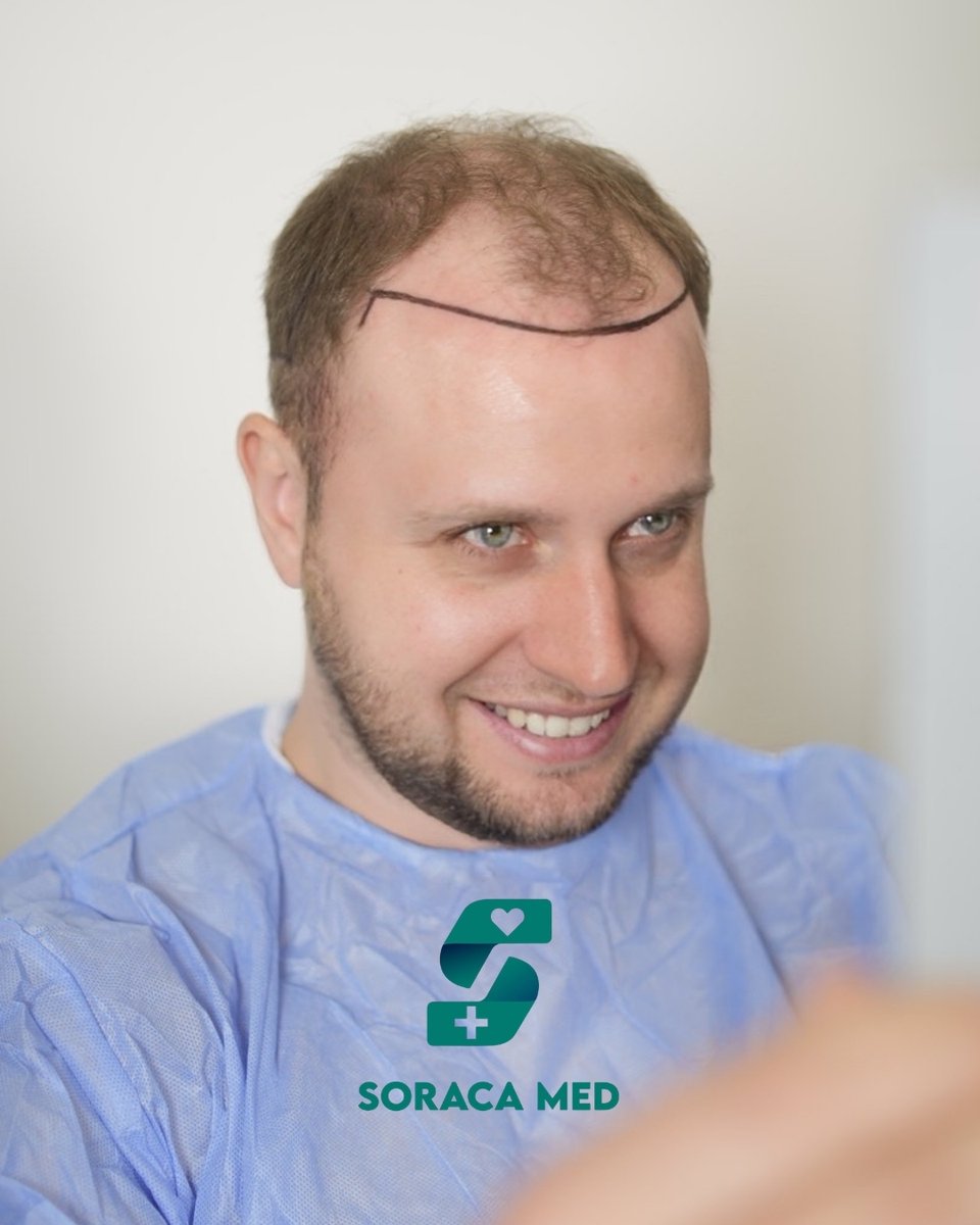 soracamed's tweet photo. Restoring confidence, one graft at a time.
Natural hairline design tailored for every patient.
📍 Antalya, Turkey
#HairTransplant #HairRestoration #BeforeAfter #SoracaMed

https://t.co/om8k2LctnX https://t.co/NjcjqtS3Hn