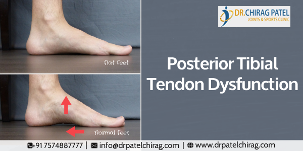 What You Need to Know About Posterior Tibial Tendon Dysfunction

Patients are recommended braces and orthotics initially to relieve pain and provide stability to the feet but if these tools fail to do the job, then surgery is the only option left. 
drpatelchirag.com/blog/posterior…