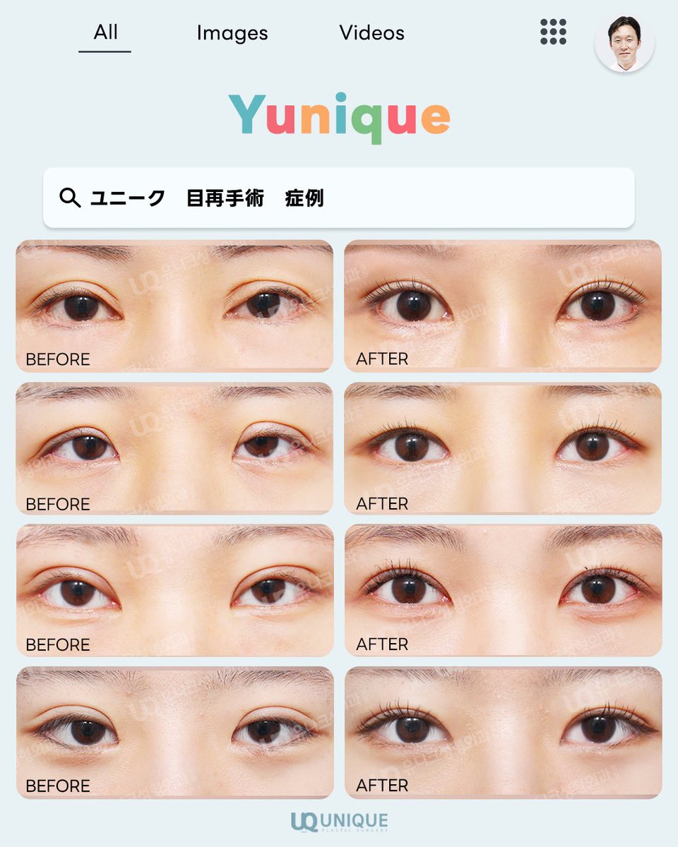 unique__jp's tweet photo. ユニーク美容外科の #目再手術 症例を公開！👀

当院では、豊富な経験とノウハウを持つ専門医が、一人ひとりの目の状態に合わせて、自然で美しい二重ラインを再建します😊

お気軽にお問い合わせください！
https://t.co/p9OKQ5dkmZ

#目整形 #二重整形  #韓国整形 https://t.co/GDlVl1vhoE