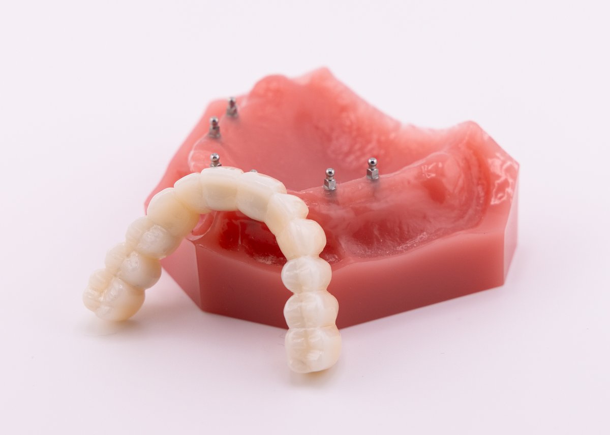 SunshineDentaI's tweet image. Dentures that shift or feel loose can be frustrating. Discover how Fix-on-Six with mini implants creates a more secure, stable solution! #Albuquerque #Implant #Dentist bit.ly/4vOMnXG
