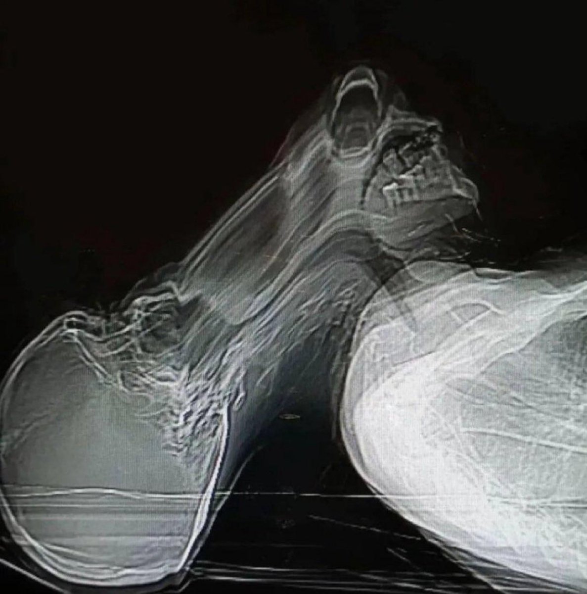 Result of sneezing during CT scan