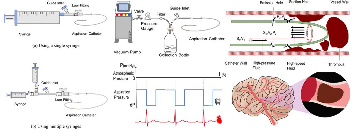medntdj's tweet image. Recent development of aspiration pump in the aspiration thrombectomy system
sciencedirect.com/science/articl…
#Aspiration pump #Thrombus #Thrombectomy #Vascular embolic diseases #Aspiration thrombectomy #MedTwitter #scicomm #MedEd #AcademicTwitter