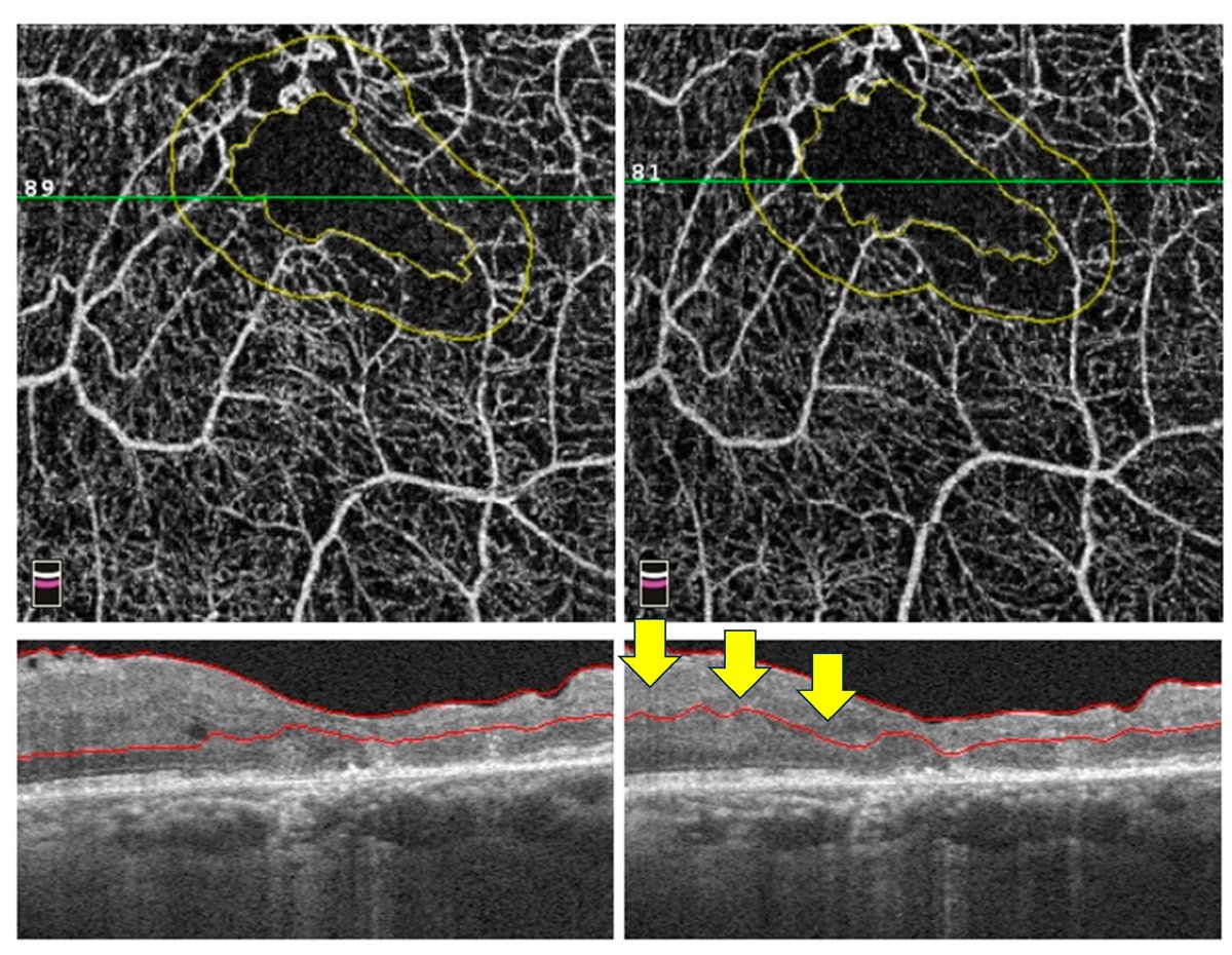 diagnostic_mdpi's tweet image. 👁️🔬 OCTA in diabetic retinopathy

Can optical coherence tomography angiography improve early detection and monitoring?

👉 mdpi.com/2075-4418/14/3…

#Ophthalmology #Diagnostics #MedicalImaging