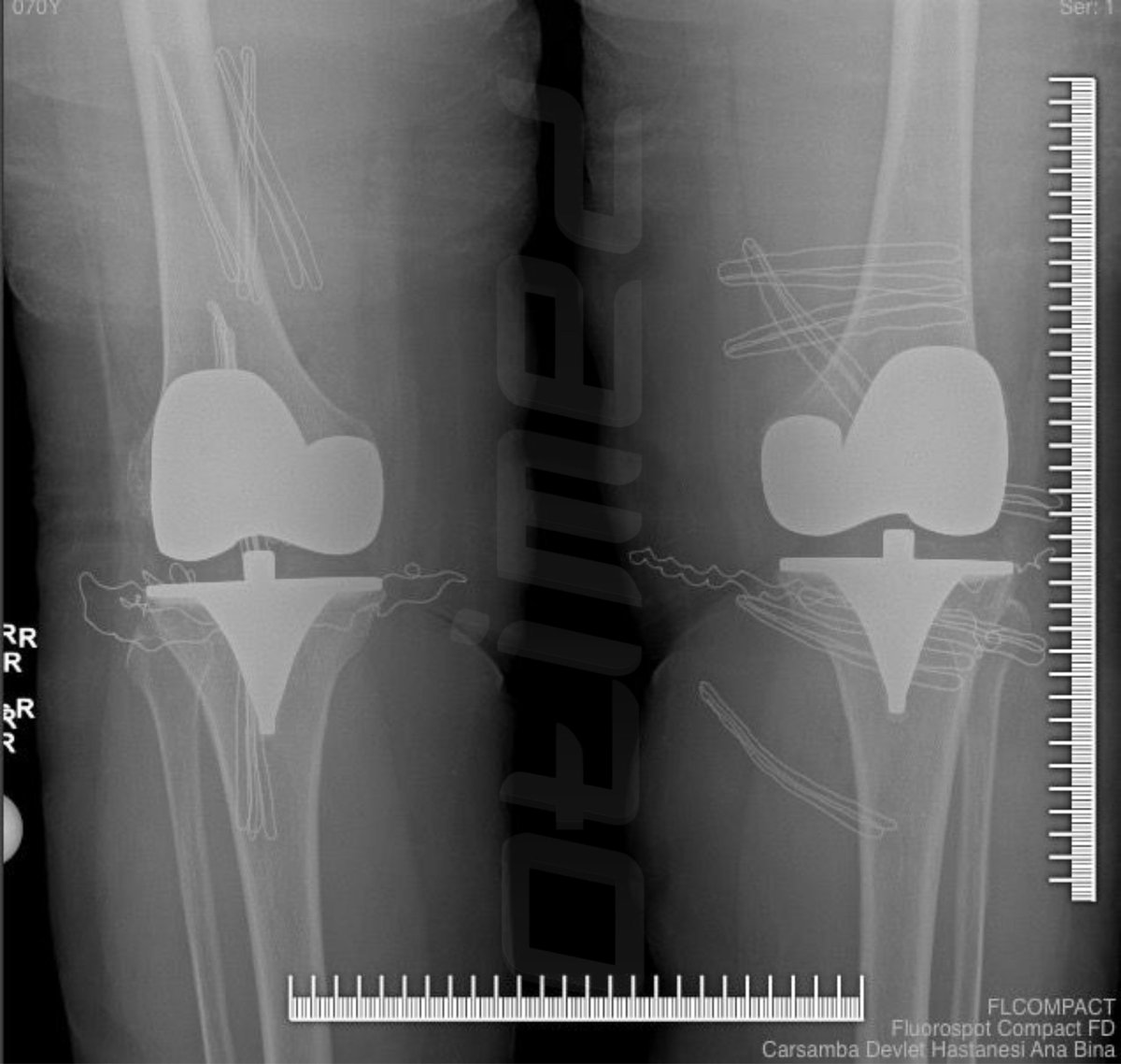 otimedofficial's tweet image. Precision, durability and functional success in modern knee arthroplasty. Otimed knee prosthesis solutions support mobility through advanced orthopedic technologies.

#KneeImplant #Arthroplasty #Orthopedics #Otimed #MedTech