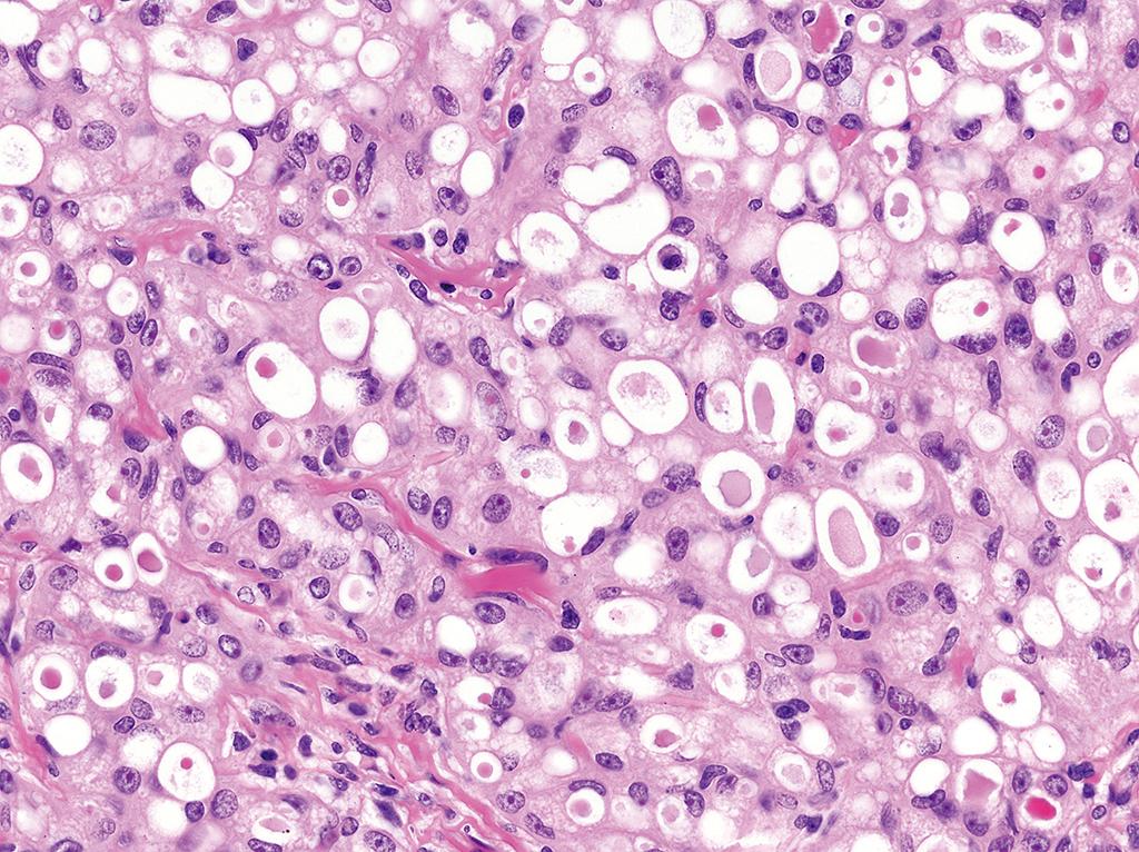 DrCycloPath's tweet photo. #PathQuiz 🔬

A) Secretory carcinoma
B) Mucinous carcinoma
C) Adenoid cystic carcinoma
D) Hidradenoma

#Pathology #DermPath https://t.co/wC6oGxadaJ