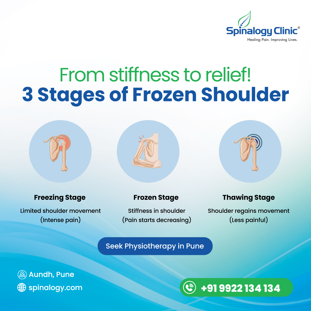 spinalogy's tweet photo. Say goodbye to shoulder stiffness 👋

Frozen shoulder develops in phases painful restriction, stiffness, then gradual recovery. 
Recovery is closer than you think!

Get Appointment: https://t.co/Pjy5hj25mn

#FrozenShoulder #PhysiotherapyPune #ShoulderPain #PainRelief #Spinalogy https://t.co/6YDCoQKPzZ