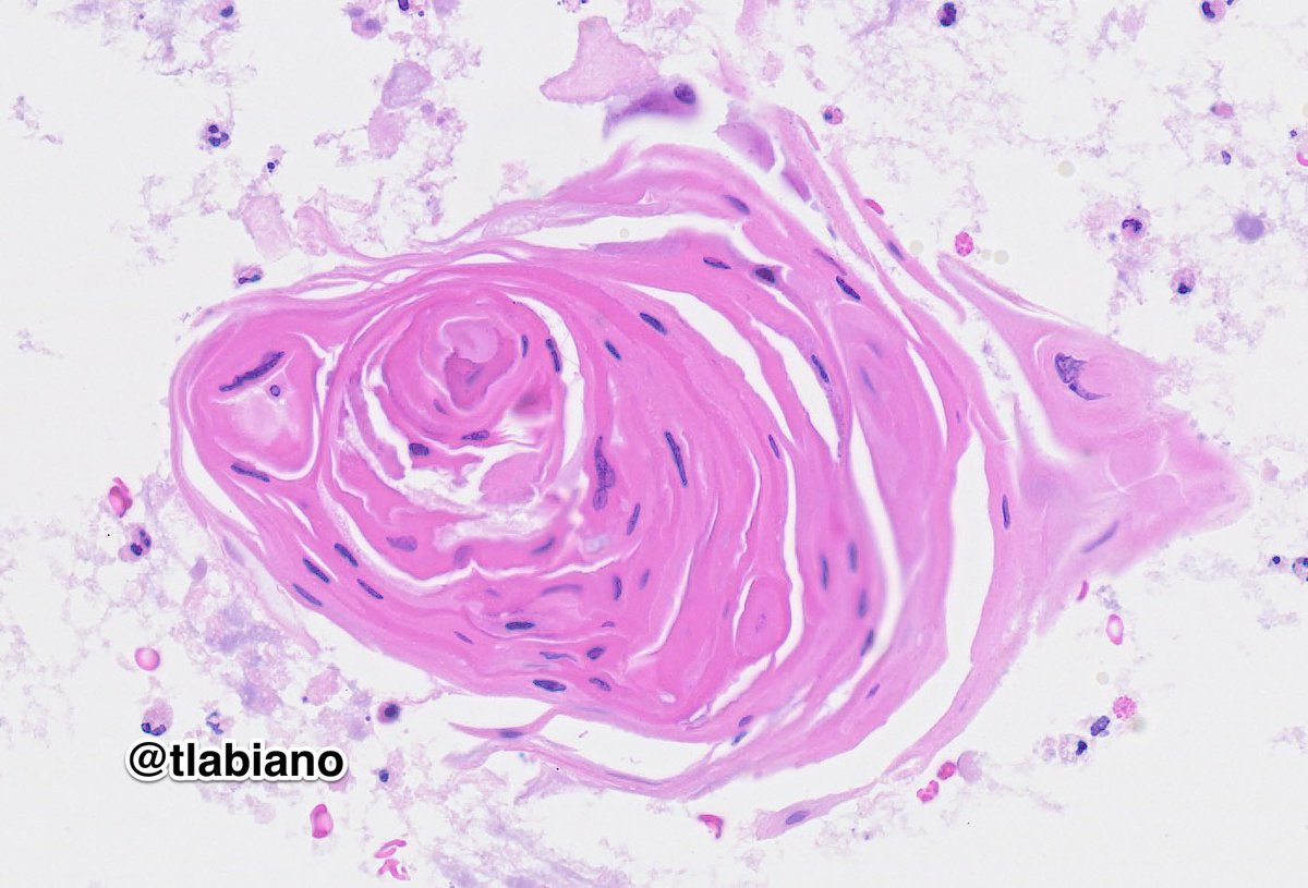 tlabiano's tweet photo. 🔬💍🏐🧡Keratinizing pearls of squamous cell carcinoma. 

🤼‍♀️🥊💞 Smear &amp; cell block photomics for cyto-histo correlation lovers 🤓🫶🏼

💉Seen in cervical lymph node #FNA (90yo female) cytology 

#cytopath #pathart #headNeckPath #PAPvsHE  #cytopearls #iphone17ePic https://t.co/yhChu8PVRq