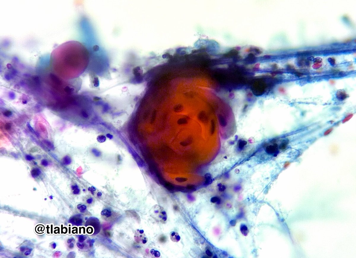 tlabiano's tweet photo. 🔬💍🏐🧡Keratinizing pearls of squamous cell carcinoma. 

🤼‍♀️🥊💞 Smear &amp; cell block photomics for cyto-histo correlation lovers 🤓🫶🏼

💉Seen in cervical lymph node #FNA (90yo female) cytology 

#cytopath #pathart #headNeckPath #PAPvsHE  #cytopearls #iphone17ePic https://t.co/yhChu8PVRq