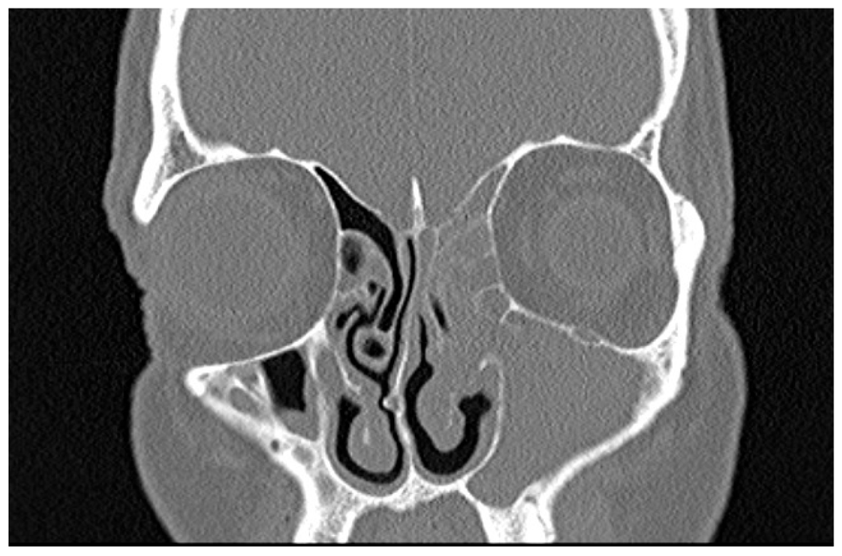 Sinusitis_MDPI's tweet photo. #LatestArticle by Zuska et al.⭐️

Role of the Lund–Mackay Score in Determining Surgical Indication in Odontogenic Chronic Rhinosinusitis🏥👃

Published: 13 April 2026 🗓️
Pages: 8 📚

🔗Full paper: https://t.co/by8kaUpynY

#Sinusitis #Rhinosinusitis #ClinicalResearch #Surgery https://t.co/ZKNUG7ESsf