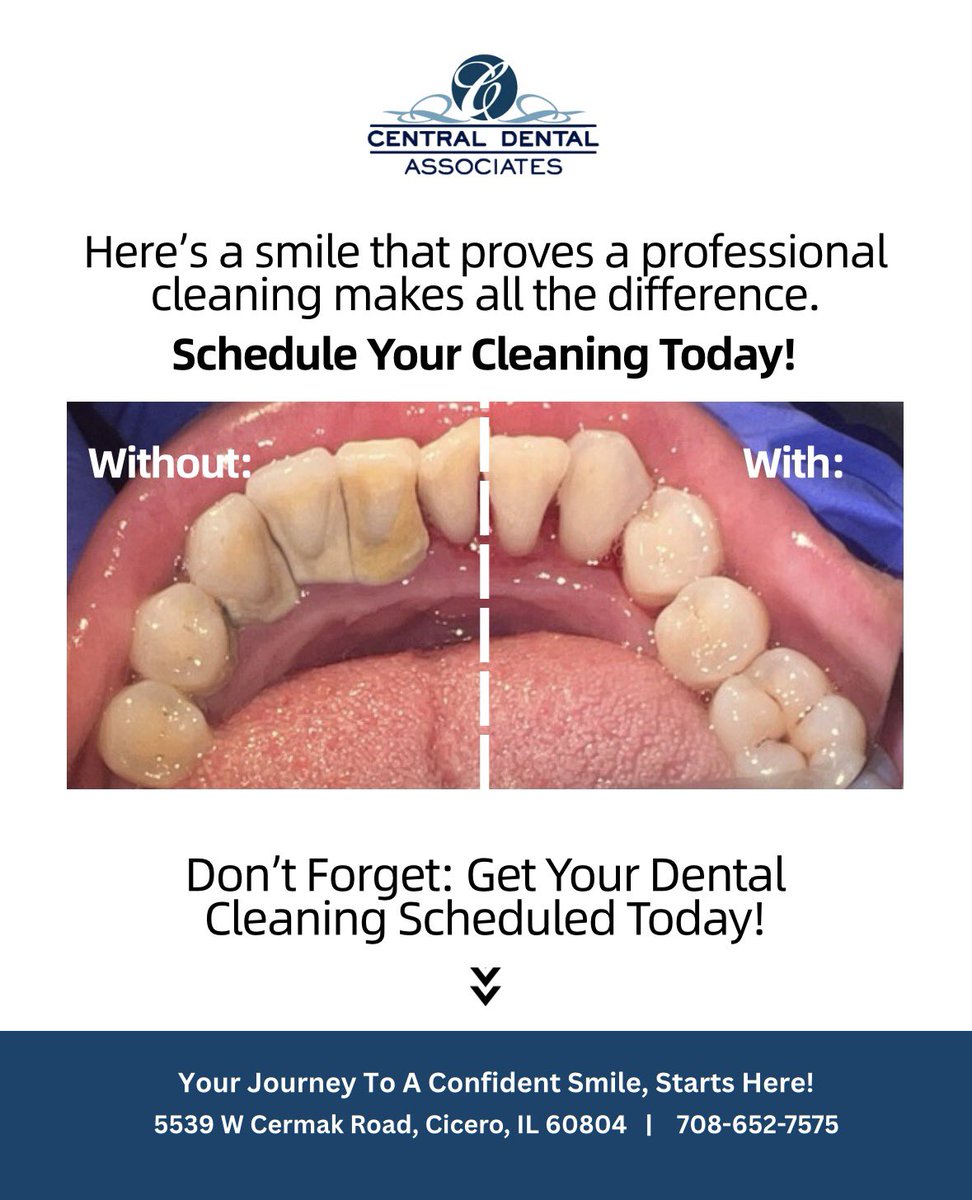 CentralDentalA's tweet image. Here’s a smile that went from buildup to bright in one visit 🦷✨ A professional cleaning can make a noticeable difference—removing plaque, polishing enamel, and bringing back that fresh, healthy glow. #fyp #beforeandafter #dentalcare #dentalcleaning