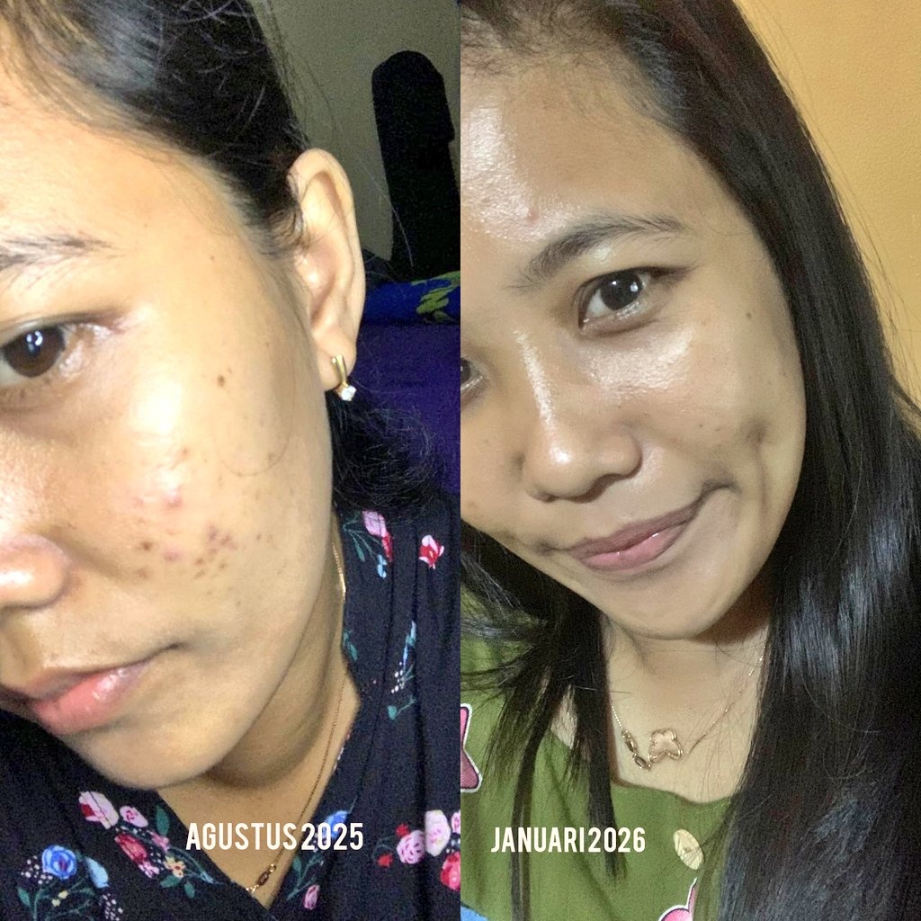 ziaaulhaq__'s tweet image. perjuangan melawan jerawat🔥 #acne #skincare