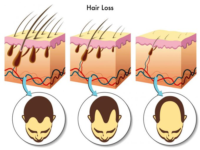 questmoosa's tweet photo. Most men panic when hair loss kicks in, immediately jumping to finasteride or expensive surgeries in Turkey.

But research says there are better ways to restore hair, naturally.

Here’s everything you need to know: 🧵 https://t.co/rkXyauuf8l