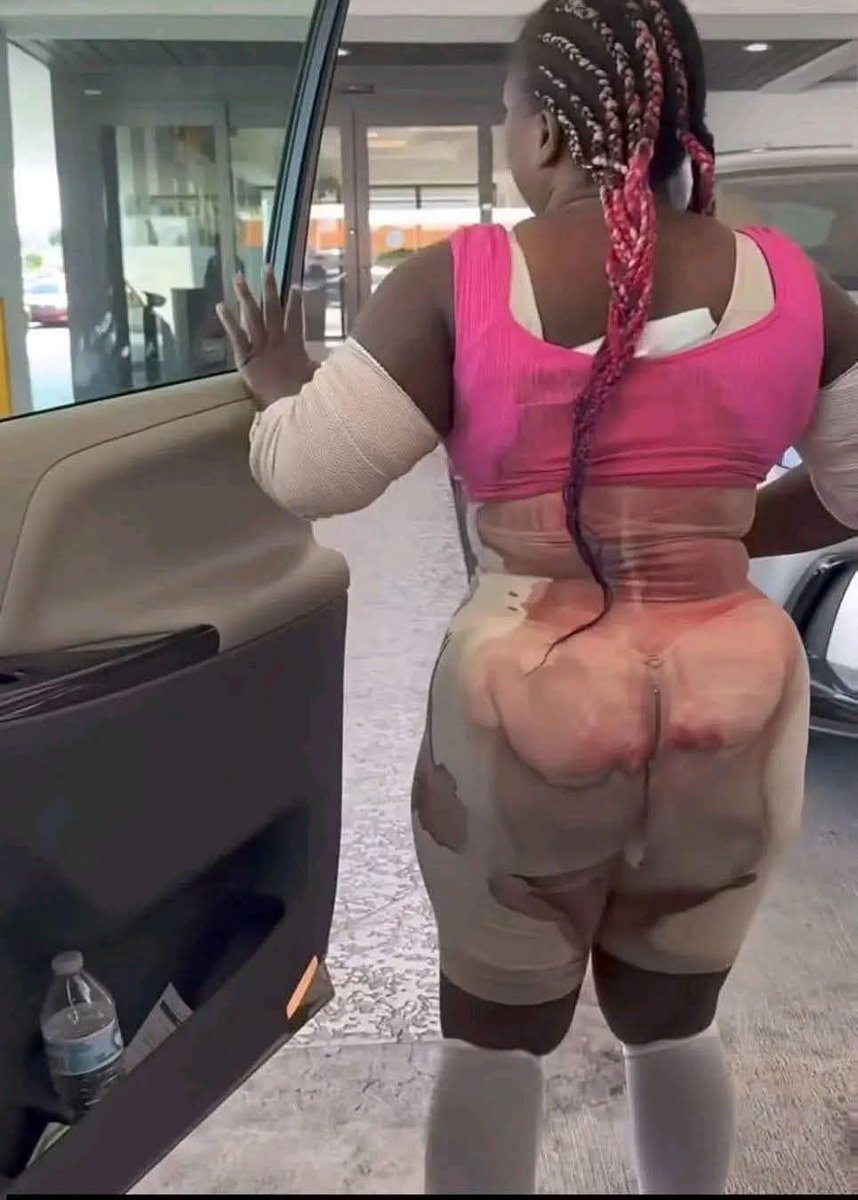 Nairaupdate's tweet photo. Some people lie in hospital beds, enduring intense pain and yearning for good health. Meanwhile, others in perfect health willingly undergo surgery, bearing pain to change their body shape.

 The contrast is striking and deeply thought-provoking 🤔😮😳 

#bblsurgery https://t.co/yTWCZAkpmf