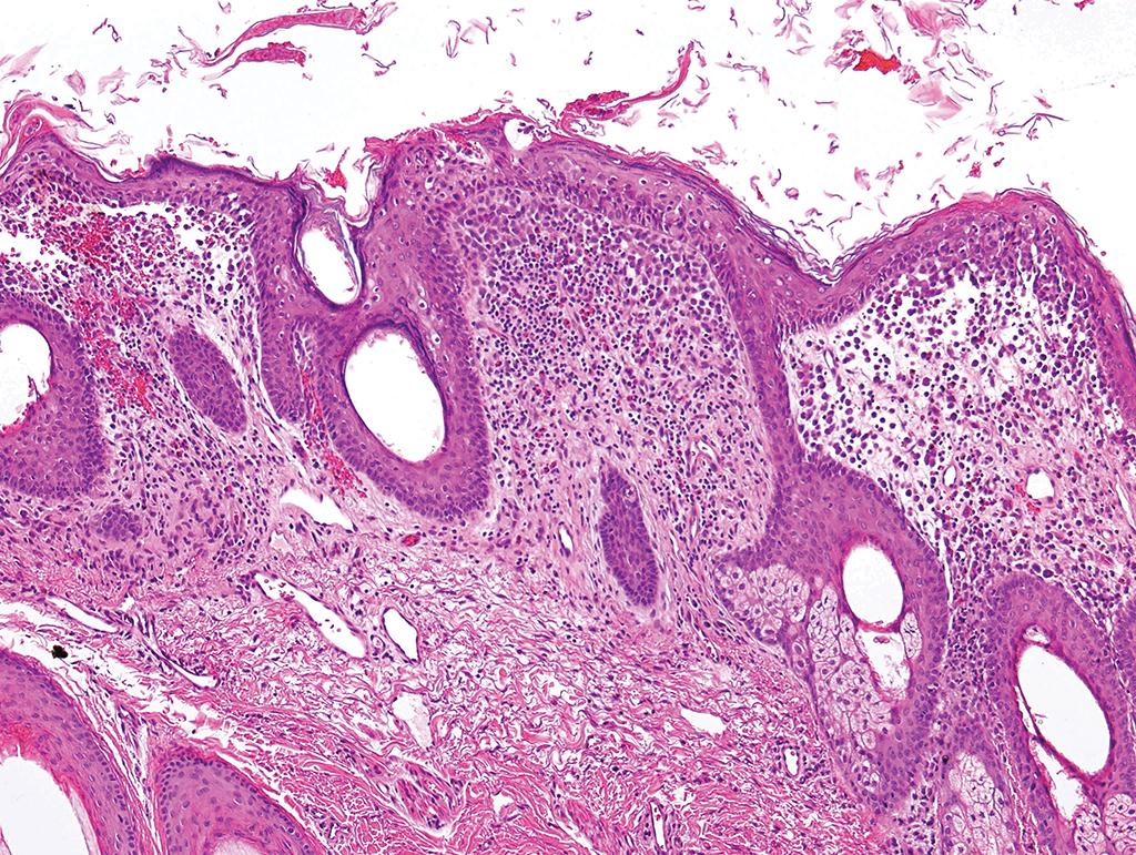 DrCycloPath's tweet image. #PathQuiz 🔬🧬 #DermPath

A) Langerhans cell histiocytosis
B) Juvenile xanthogranuloma
C) Mastocytosis
D) Rosai-Dorfman disease

#Pathology #DermPath