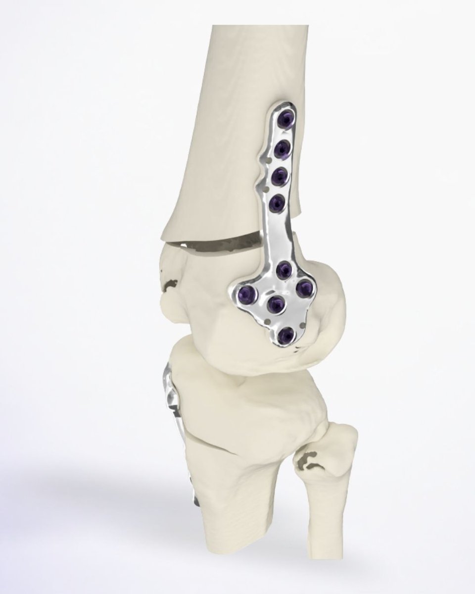 ValorImplant's tweet photo. What a biomodel makes visible before surgery

It can be highly useful in unique and complex surgeries, helping surgeons orient themselves in the operating room and verify how the guide fits the patient's anatomy. https://t.co/0vS6HmufvK
