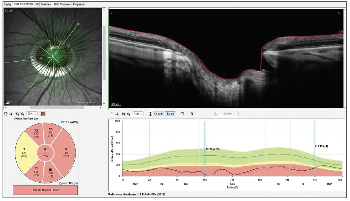 revoptom's tweet image. Peace of Mind, For the Patient and the Doctor

Clear baselines, transparent decisions and steady follow‑up help ease concerns after transfer and validate therapeutic choices.

Read the latest Glaucoma Grand Rounds: reviewofoptometry.com/article/peace-…

#glaucoma #optometry #eyecare