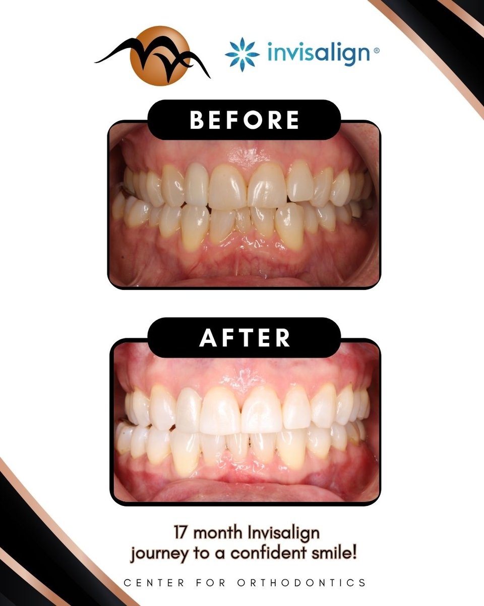 drminanarula's tweet image. 17 months to this dreamy smile 😁

From before to wow—your glow up is next 💫 book your consultation today 🤍
#smileglowup #invisalign #beforeandafter #coachellavalley #palmdesert #ranchomirage #confidenceera #smilegoals #orthodontics