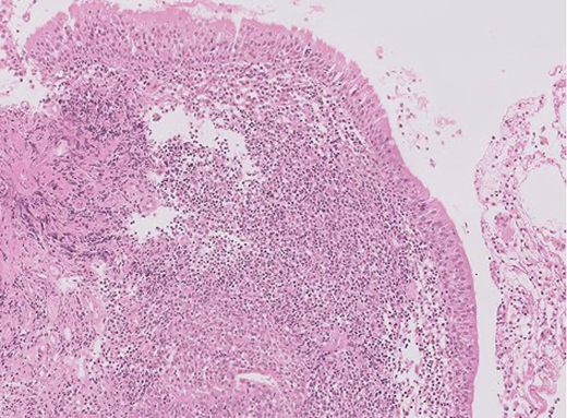 jhumimmunity's tweet photo. New study from Bhattad, Singh, et al. analyzes the records of five Activated phosphoinositide 3-kinase δ syndrome 1 (APDS1) patients, representing the first case series of APDS1 from the Indian subcontinent. https://t.co/kvMOWCzYdC 
#InbornErrorsOfImmunity https://t.co/08e5NYua6E