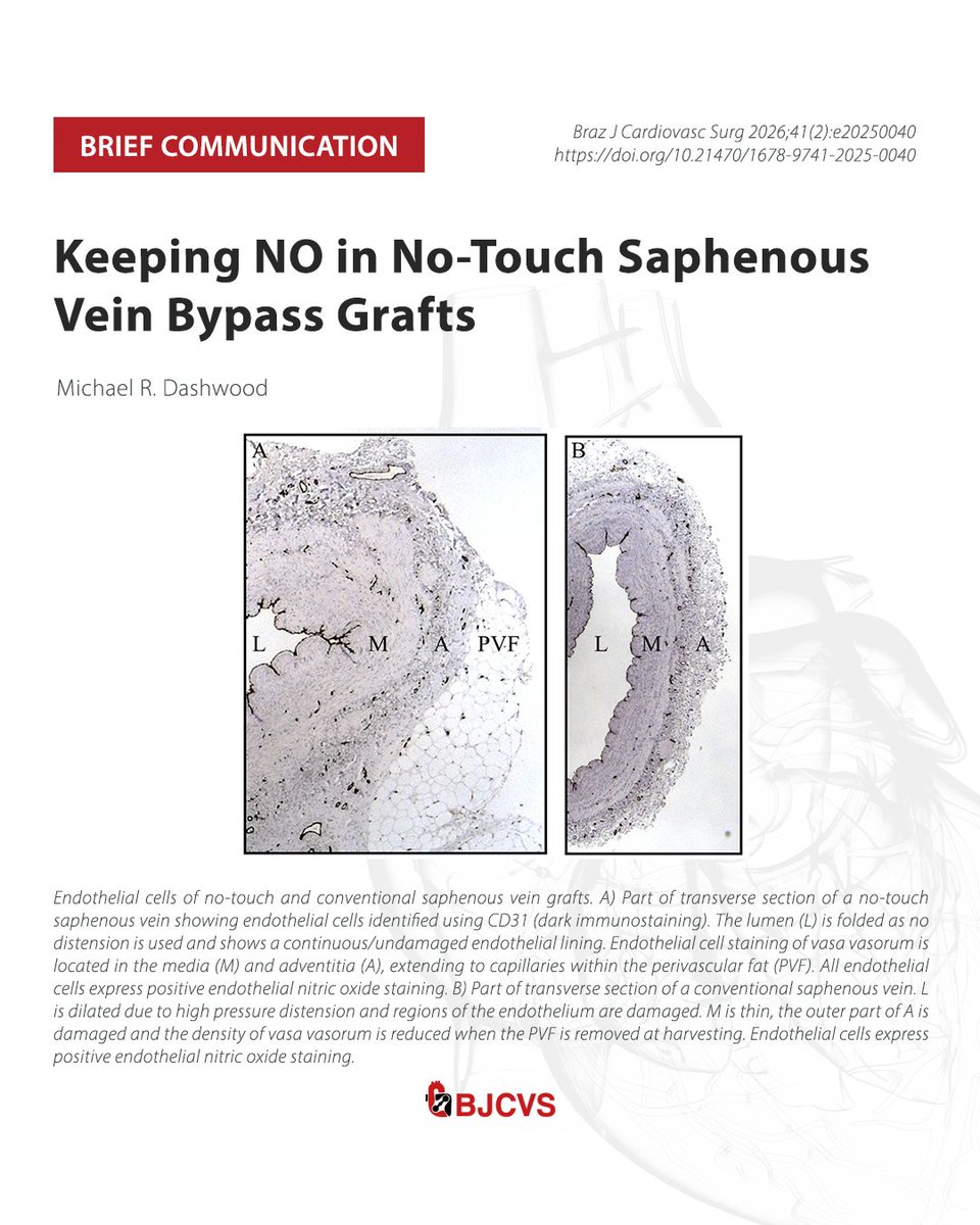 bjcvs's tweet image. The Power of Nitric Oxide: Revolutionizing Bypass Grafts 

Read the article: bit.ly/41pAGIU

#Cardiology #HeartSurgery #NitricOxide